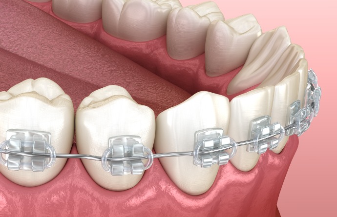 Imagen dientes con brackets
