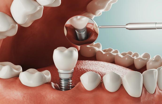 imagen implante dental